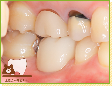 症例1 インプラント 治療後の写真