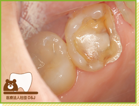 症例24 プレスセラミックインレー 治療中の写真