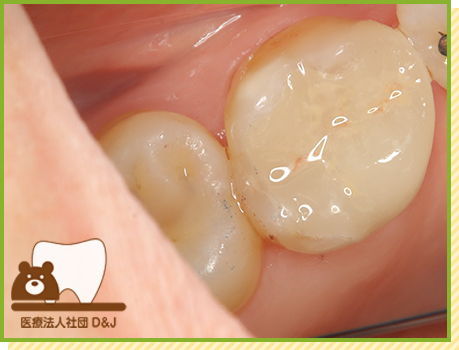 症例24 プレスセラミックインレー 治療後の写真
