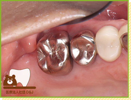 症例16 フルジルコニアクラウン 治療前の写真