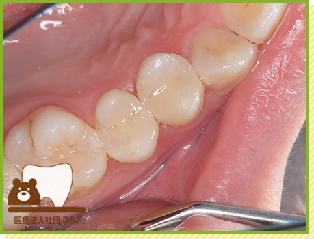 症例25 オールセラミックインレー 治療後の写真