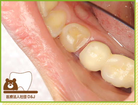 症例26 オールセラミックインレー 治療中の写真