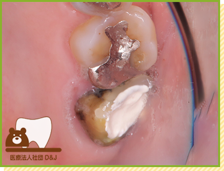 症例17 フルジルコニアクラウン 治療前の写真