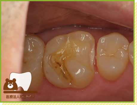 症例27 ゴールドインレー 治療中の写真