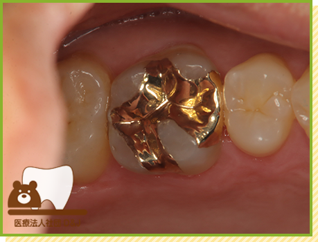 症例27 ゴールドインレー 治療後の写真