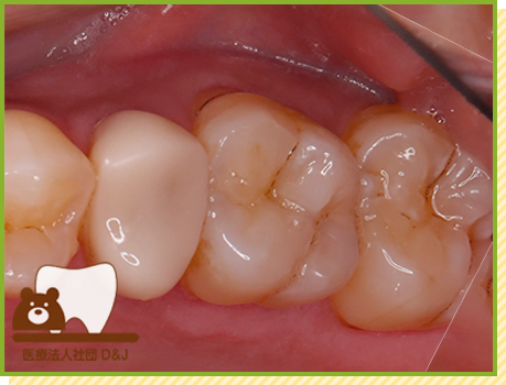 症例28 ハイブリットインレー 治療前の写真