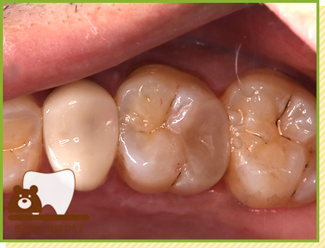 症例28 ハイブリットインレー 治療後の写真