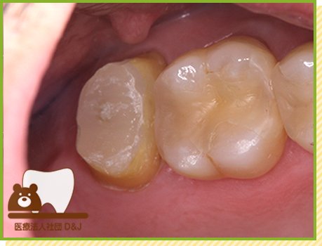 症例18 フルジルコニア・ファイバーコア 治療中の写真