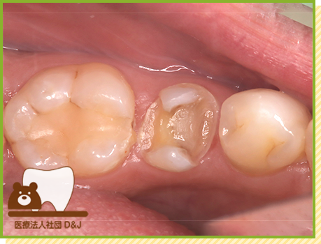 症例29 オールセラミックインレー 治療中の写真