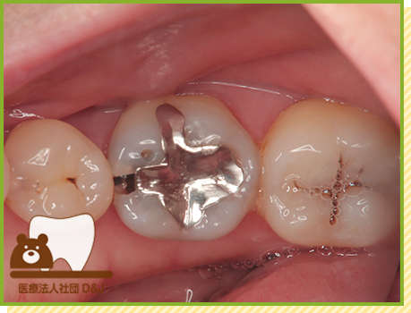 症例30 プレスセラミックインレー 治療前の写真