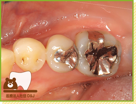 症例31 E-MAXインレー 治療前の写真