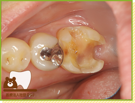 症例31 E-MAXインレー 治療中の写真