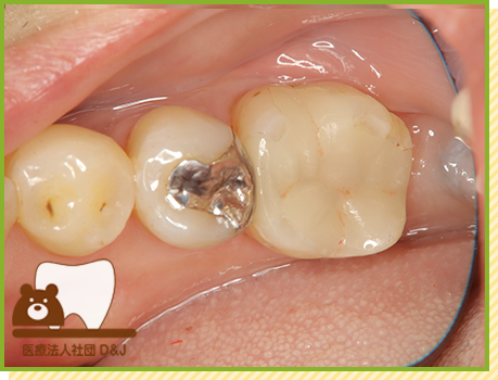 症例31 E-MAXインレー 治療後の写真