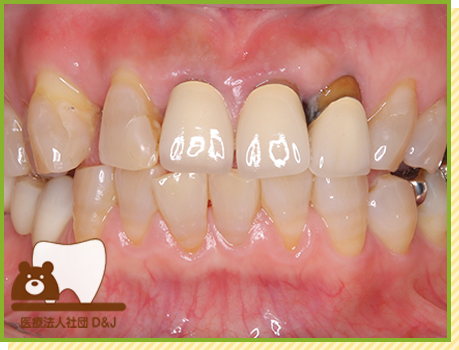 症例19 E-MAXクラウン 治療前の写真