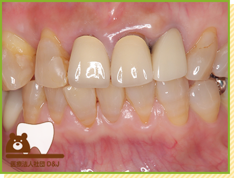 症例19 E-MAXクラウン 治療後の写真