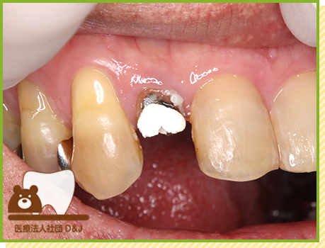 症例20 E-MAXクラウン 治療中の写真
