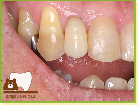 症例20 E-MAXクラウン 治療後の写真