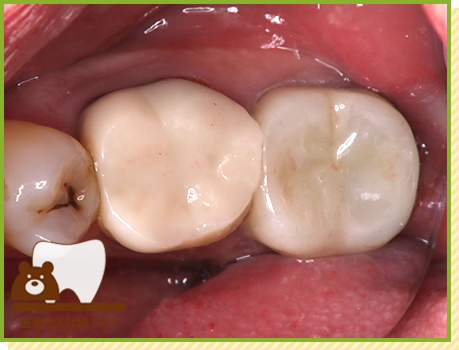 症例21 フルジルコニアクラウン 治療後の写真