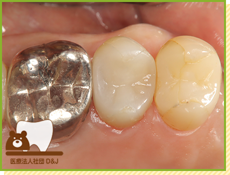 症例32 ハイブリットインレー 治療後の写真
