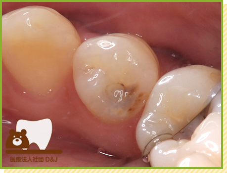 症例33 イーマックスインレー 治療前の写真