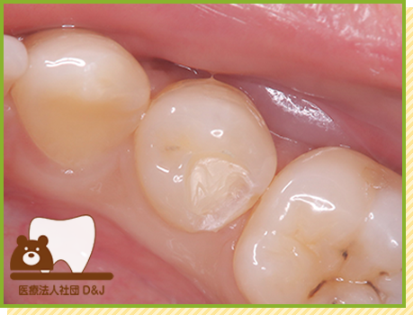 症例33 イーマックスインレー 治療中の写真
