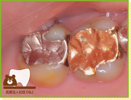 症例34 ゴールドインレー 治療前の写真