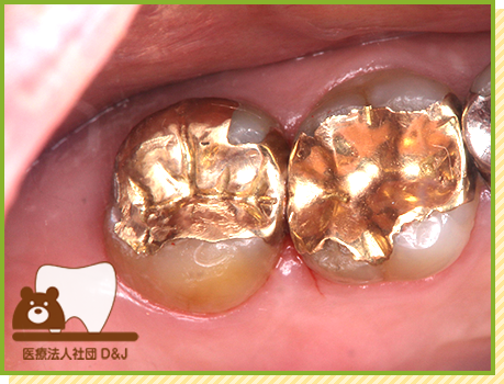 症例34 ゴールドインレー 治療後の写真