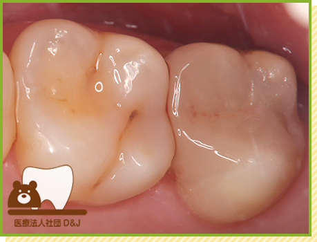 症例35 オールセラミックインレー 治療中の写真