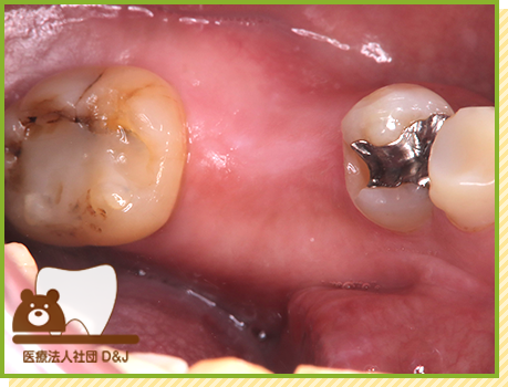 症例3 インプラント 治療前の写真