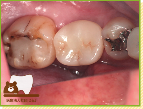 症例3 インプラント 上部構造セットの写真
