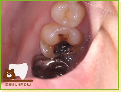 症例36 プレスセラミックインレー 治療前の写真