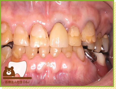 症例24 フルジルコニア 治療後の写真