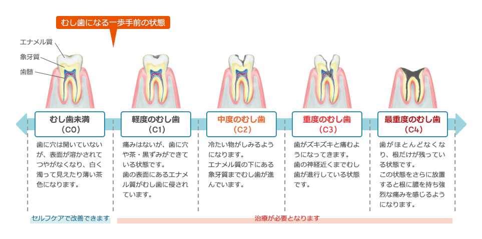 むし歯の進行のイラスト
