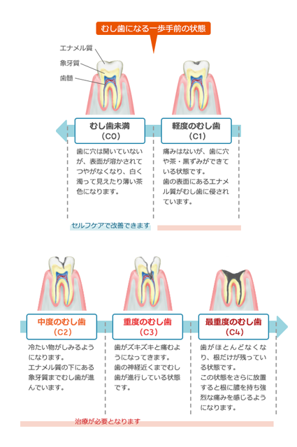 むし歯進行のイラスト