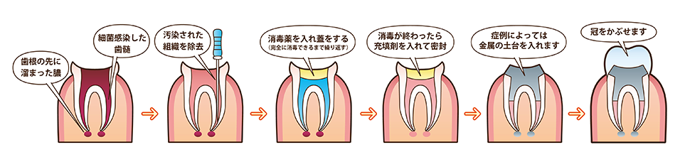 根管治療の流のイラスト