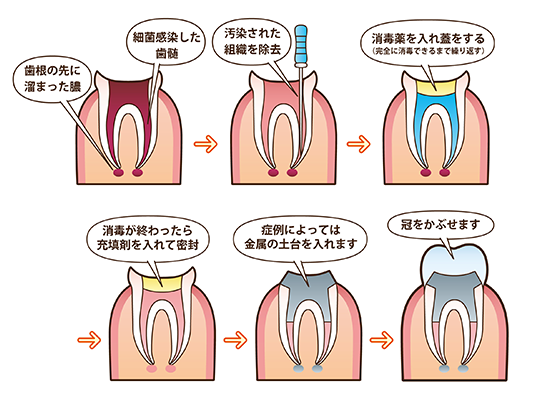 根管治療の流のイラスト