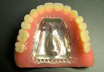 金属床(チタン)義歯の写真