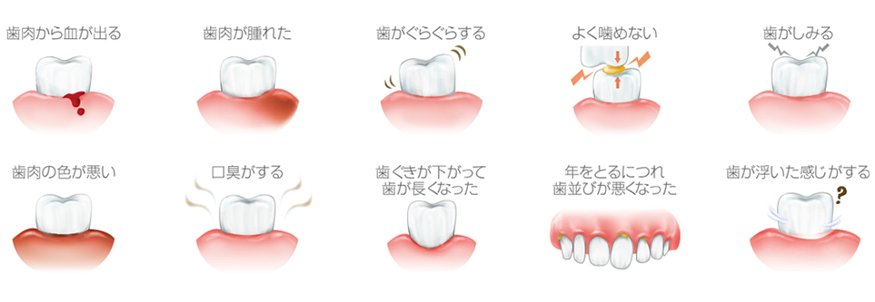 歯周病症状のイラスト