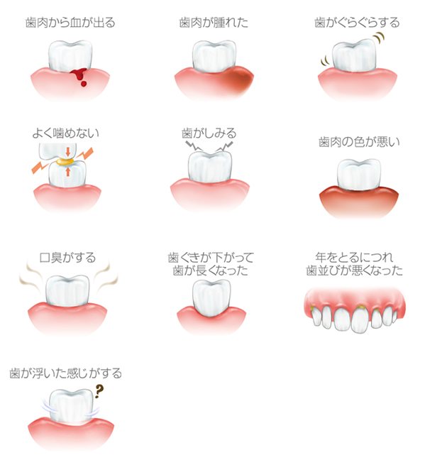 病 歯 症状 周 歯周病とはどんな病気？ ～歯肉に炎症を起こしたり、歯を支える組織が壊れたりする～