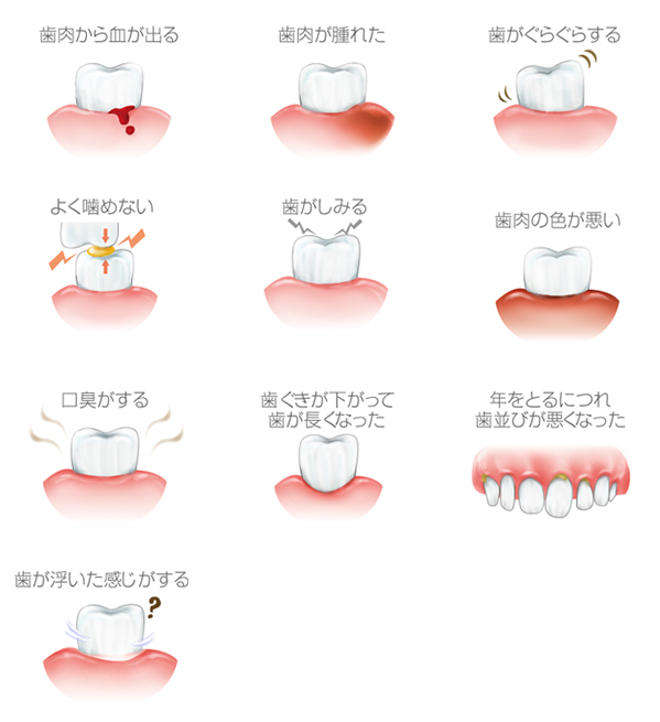 歯周病症状のイラスト