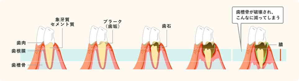 歯周病進行のイラスト