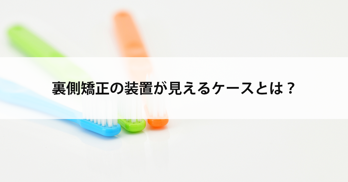 【新潟の歯医者・矯正歯科】裏側矯正の装置が見えるケースとは?