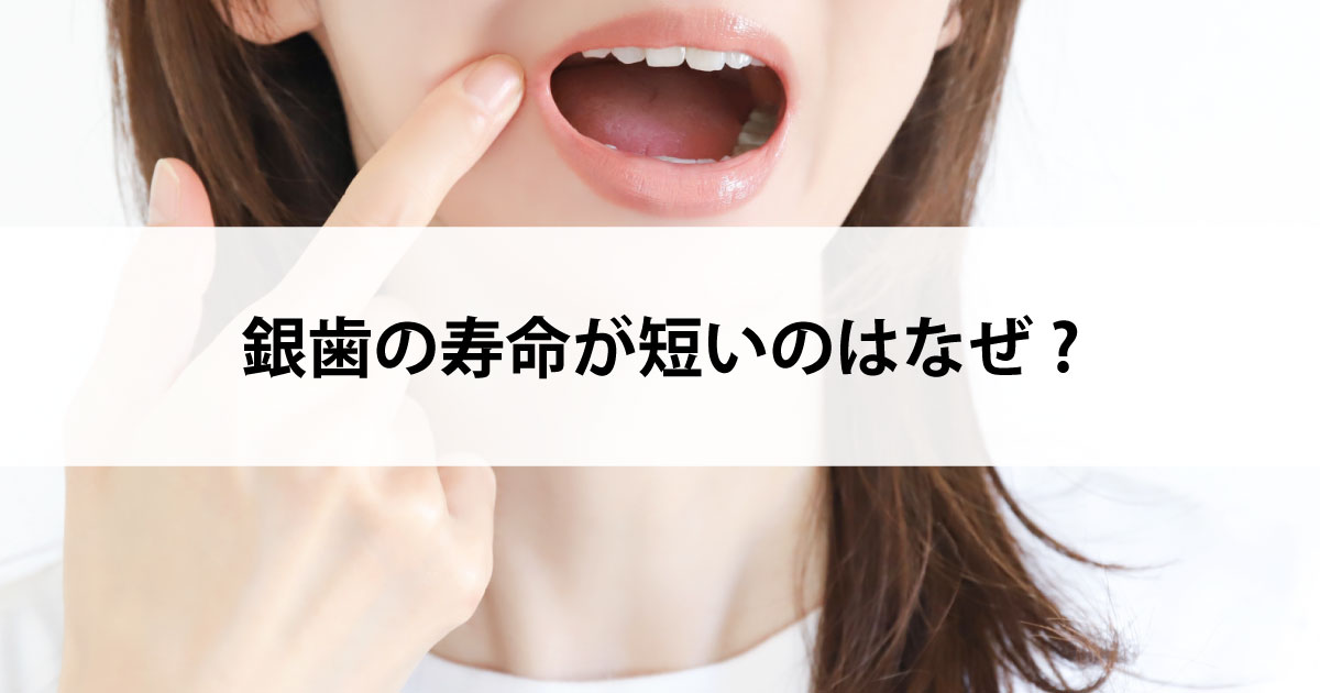 【新潟の歯医者で虫歯治療】銀歯の寿命が短いのはなぜ?